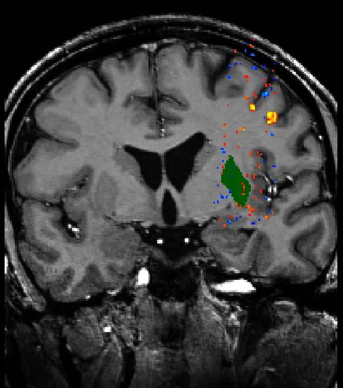 Here I have manually drawn a segmentation on my own brain, and we see the coronal view of the brain